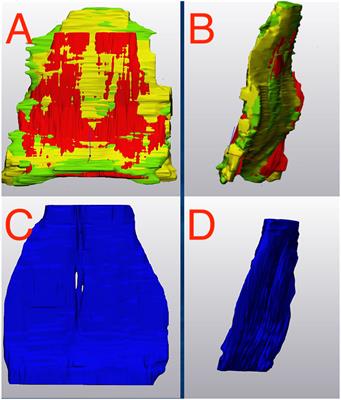 Three-Dimensional Segmentation and in silico Comparison of Equine Deep Digital Flexor Tendon Pathology in Horses Undergoing Repeated MRI Examination